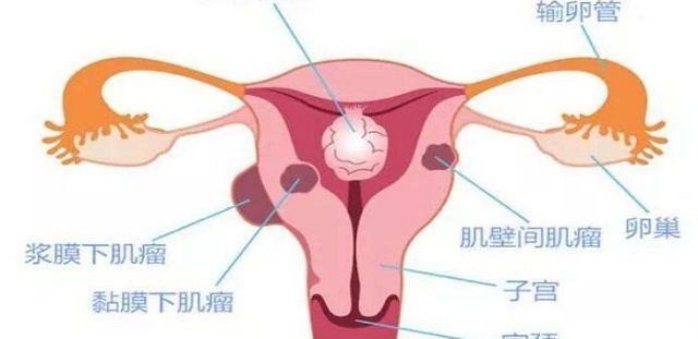 子宫肌瘤的分型