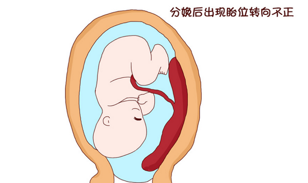 分娩后出现胎位转向不正
