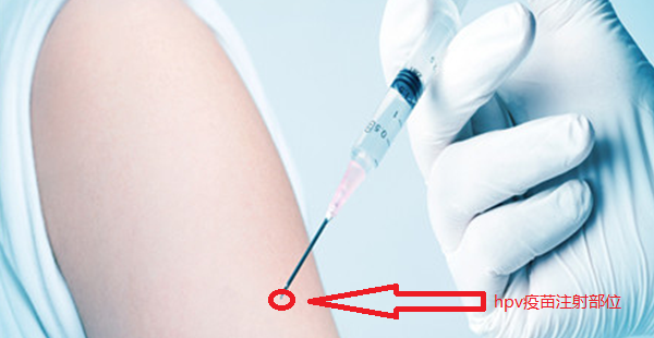 hpv疫苗注射哪个部位