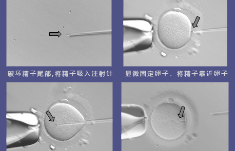 单精子卵胞浆内注射示意图