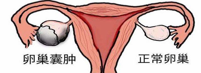 卵巢囊肿做泰国试管婴儿成功率在60％.jpg
