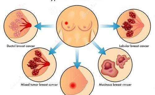 乳腺癌结构图二