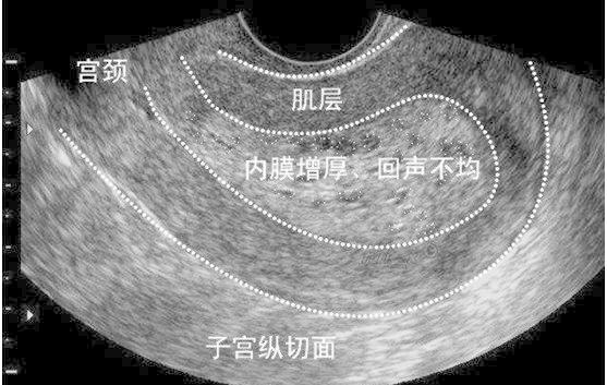子宫内膜增生的B超呈像