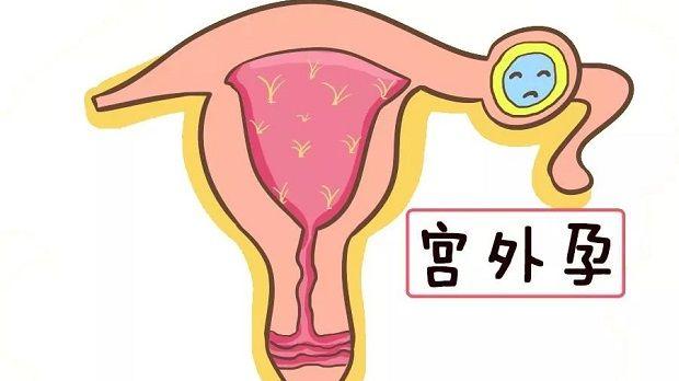 输卵管妊娠为常见宫外孕情形