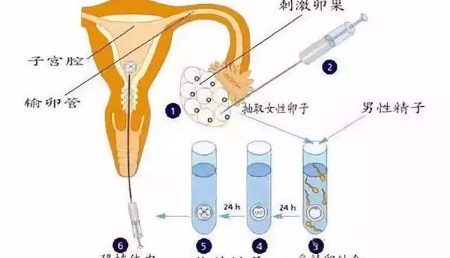 试管婴儿取卵手术流程