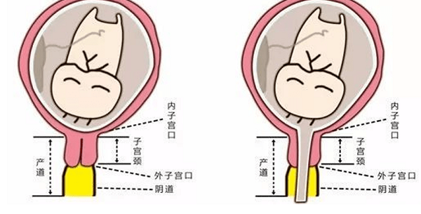 宫颈机能不全