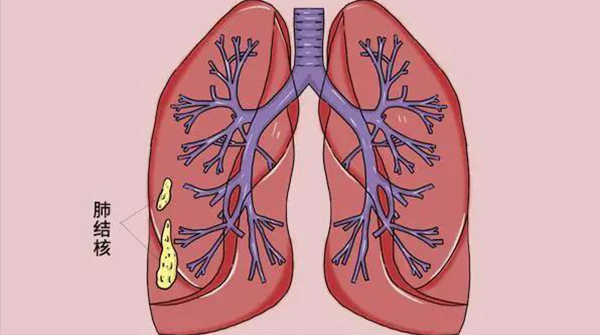 肺出现肺结核