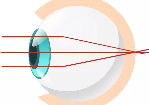 角膜弧度异常会造成散光