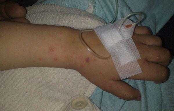 在儿童中水痘疾病很常见