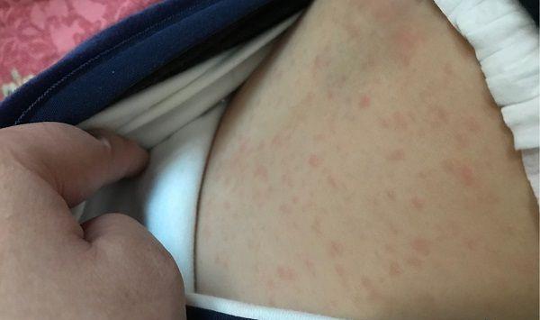 幼儿急疹一般不会出现痒的情况