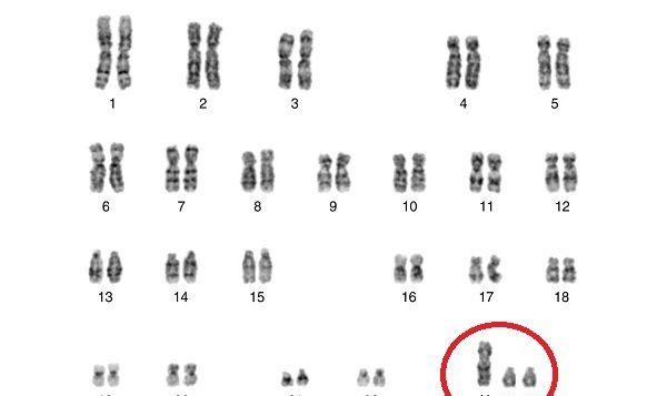 XYY染色体模型