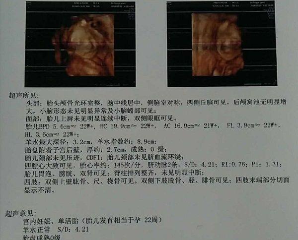 四维彩超检查