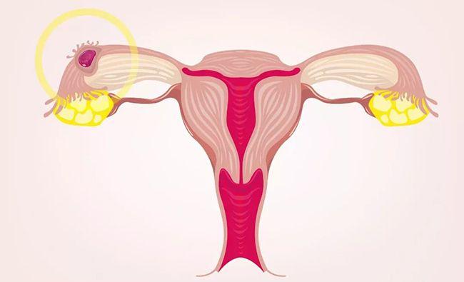 输卵管堵塞会导致女方不孕
