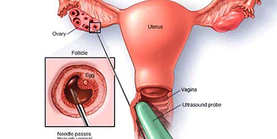 抽吸卵泡液