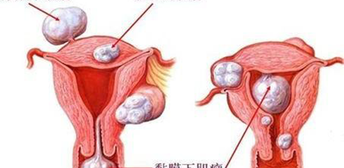 子宫肌瘤试管婴儿前治疗