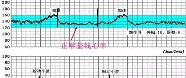 胎心率能反应出胎儿的状态