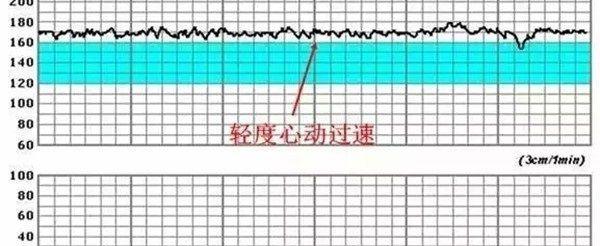 母体吸烟可能会导致胎儿FHR过速