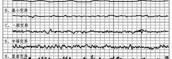 FHR基线变异分为4型