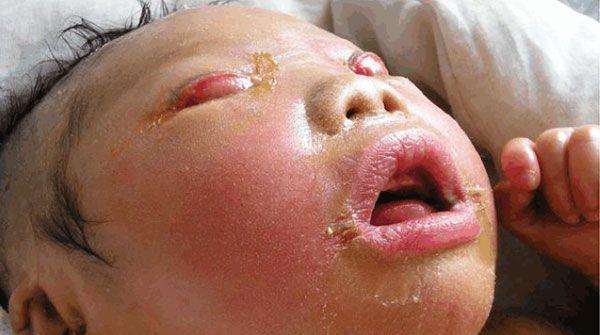 火棉胶婴儿是典型的皮肤遗传病