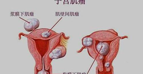 子宫肌瘤的类型