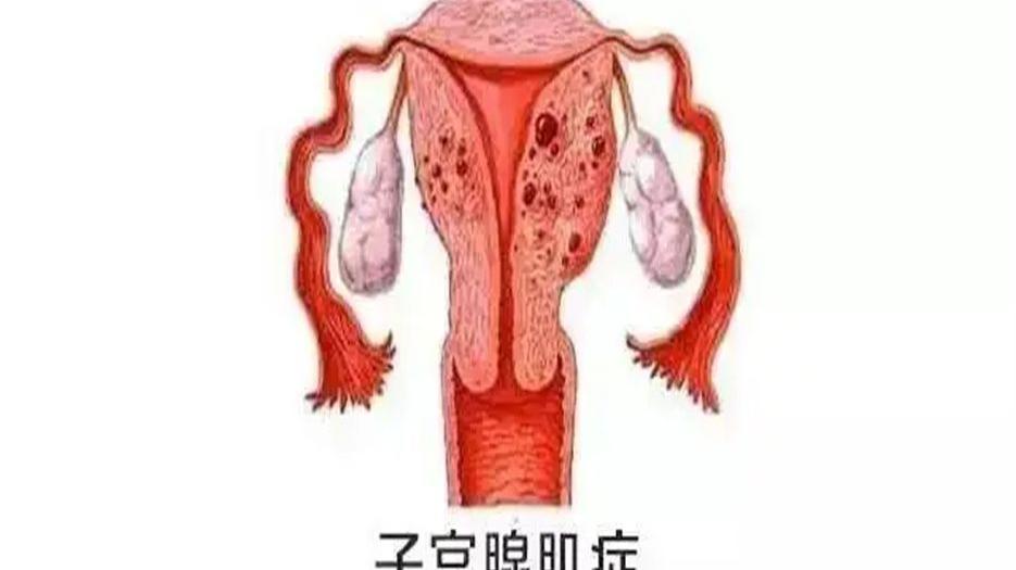 腺肌症..jpg