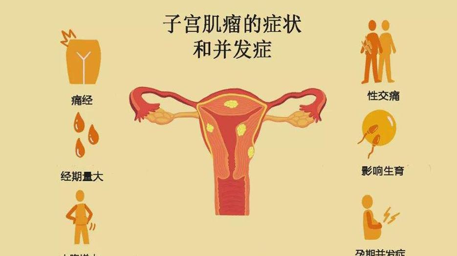 子宫肌瘤症状.jpg