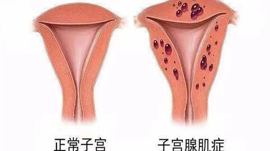 腺肌症.jpg