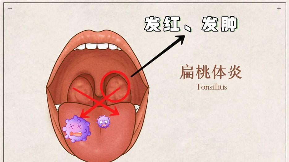 喉咙扁桃体发炎怎么办图片