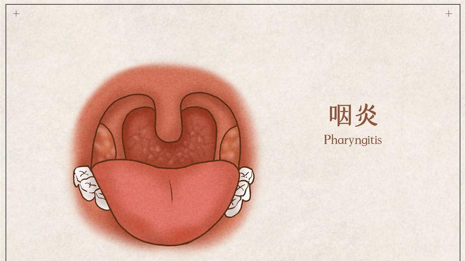 咽炎.jpg