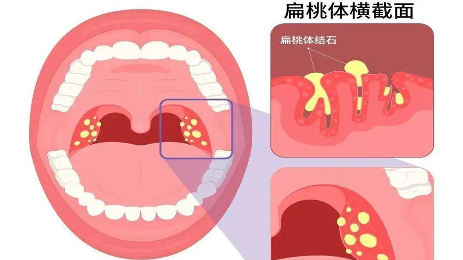 扁桃体结石.jpg