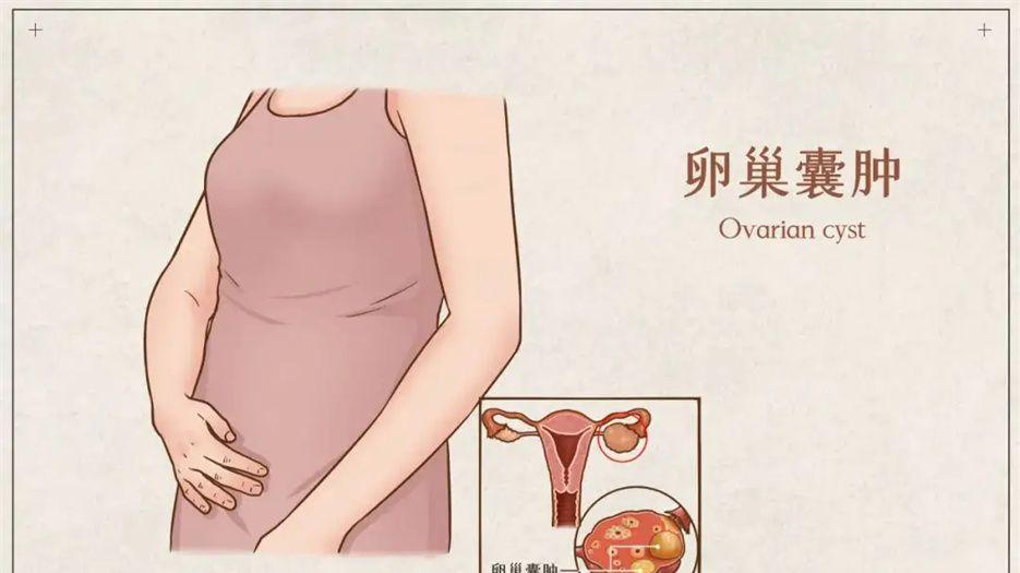 卵巢囊肿.jpg