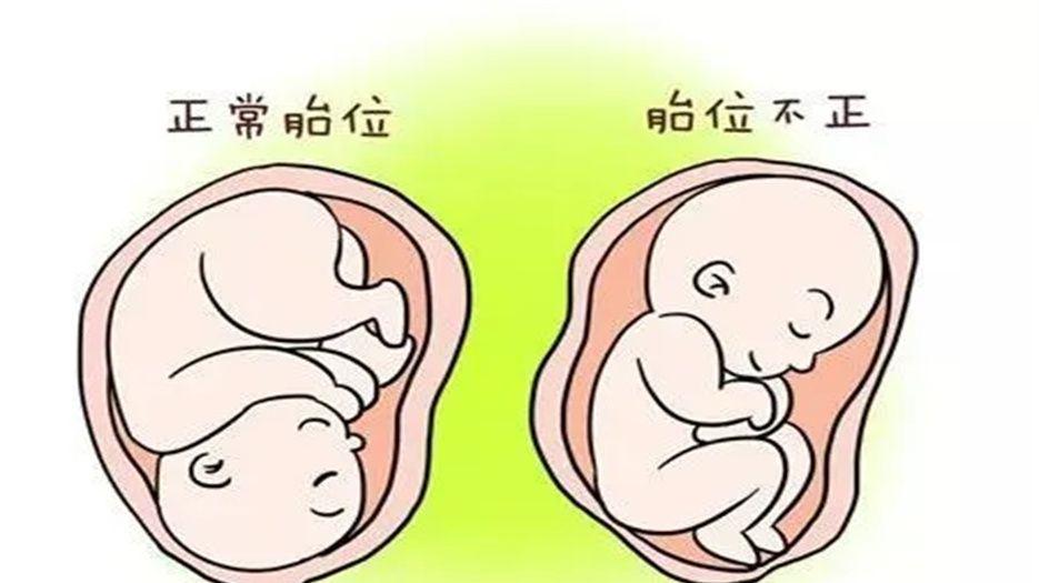 胎位不正胎儿入盆图片图片