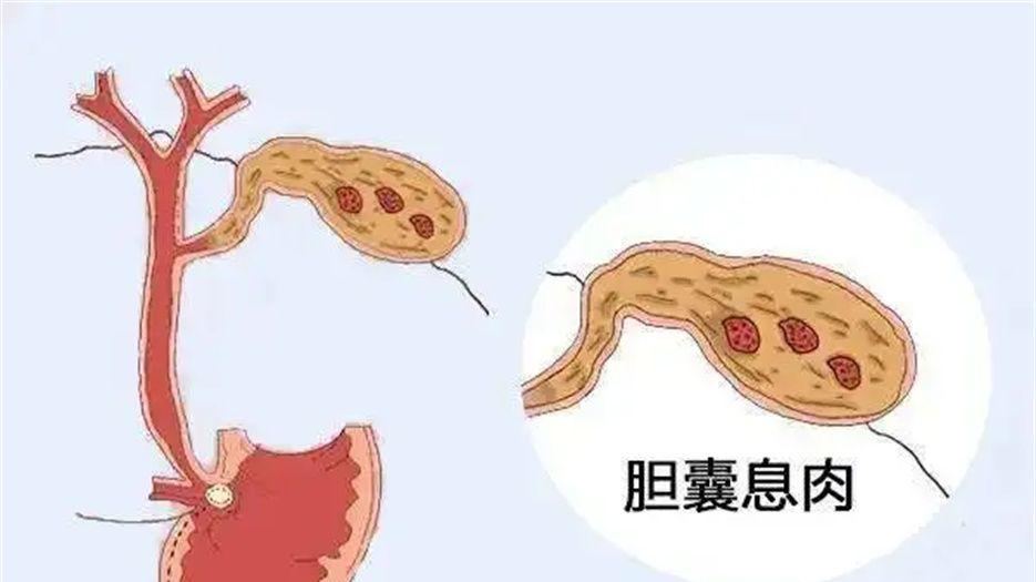 胆囊息肉.jpg