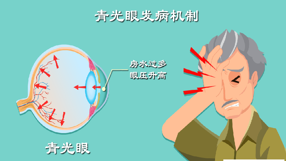 青光眼.png