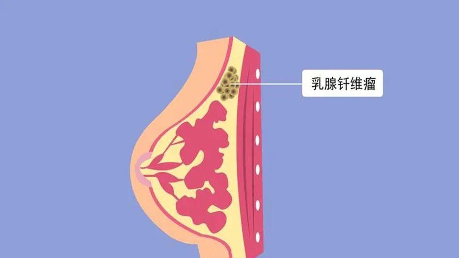 乳房纤维瘤.webp.jpg