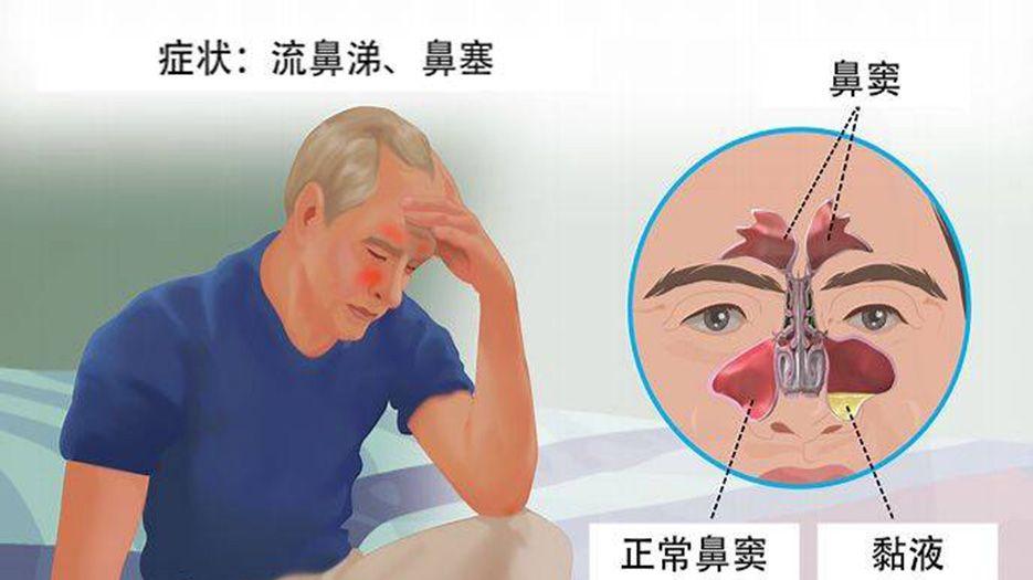 鼻窦炎.jpeg