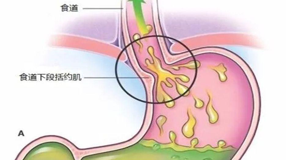 胆汁反流胃炎.jpeg