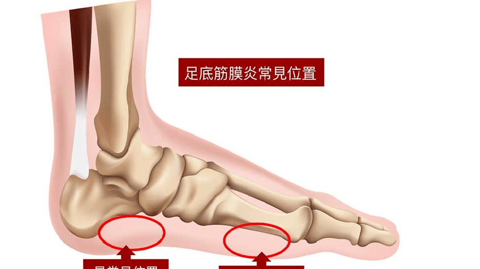 足底筋膜炎4个痛点介绍,分享3种快速止疼方法