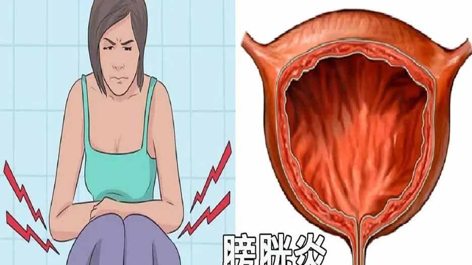 膀胱炎.webp.jpg