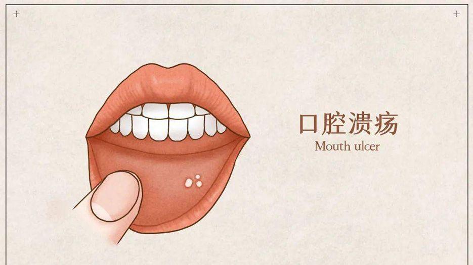 口腔溃疡.jpeg