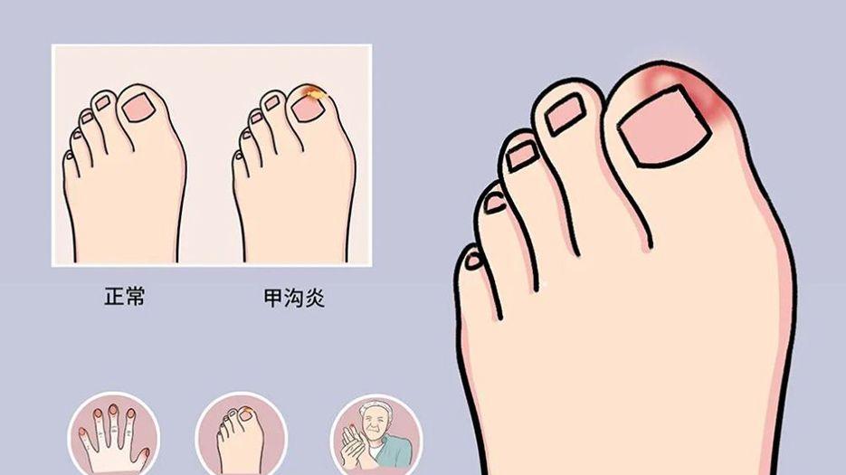 甲沟炎.jpg