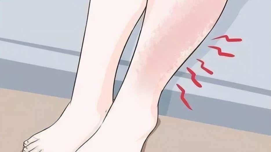 水肿.jpg