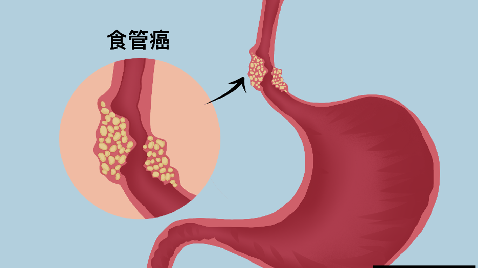 食道癌是怎么引起的图片