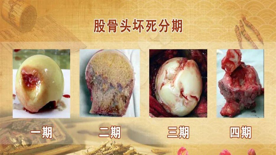 股骨头.jpeg