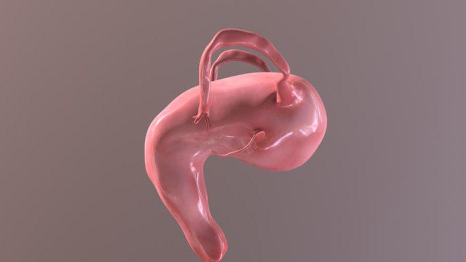 单角子宫.jpg
