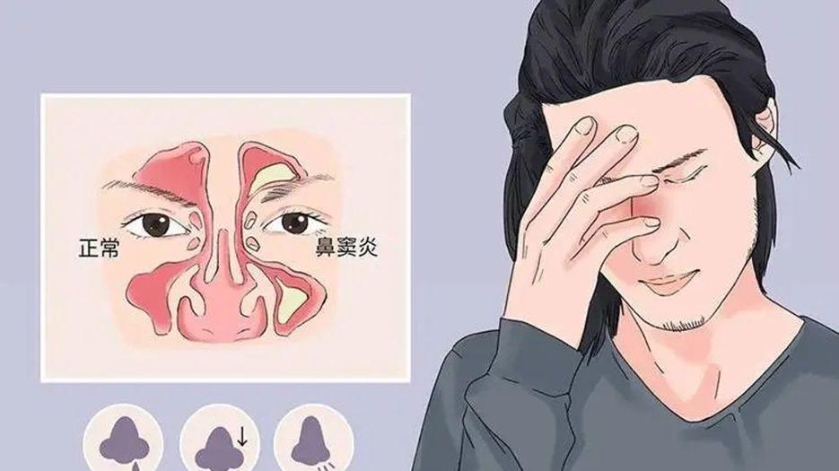鼻炎.webp.jpg