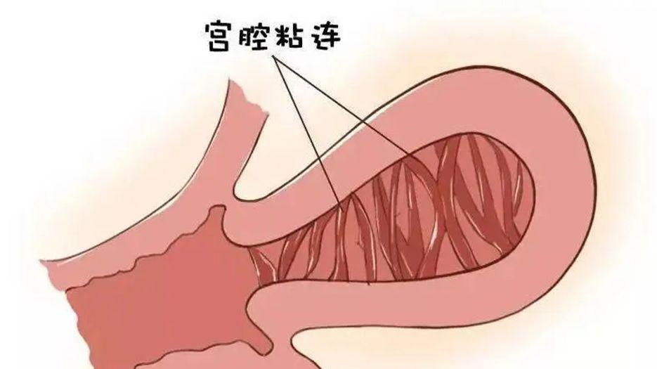 宫腔粘连.webp (1).jpg