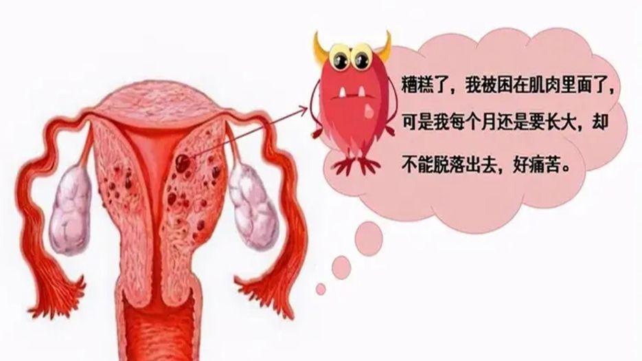 子宫腺肌症.webp (2).jpg