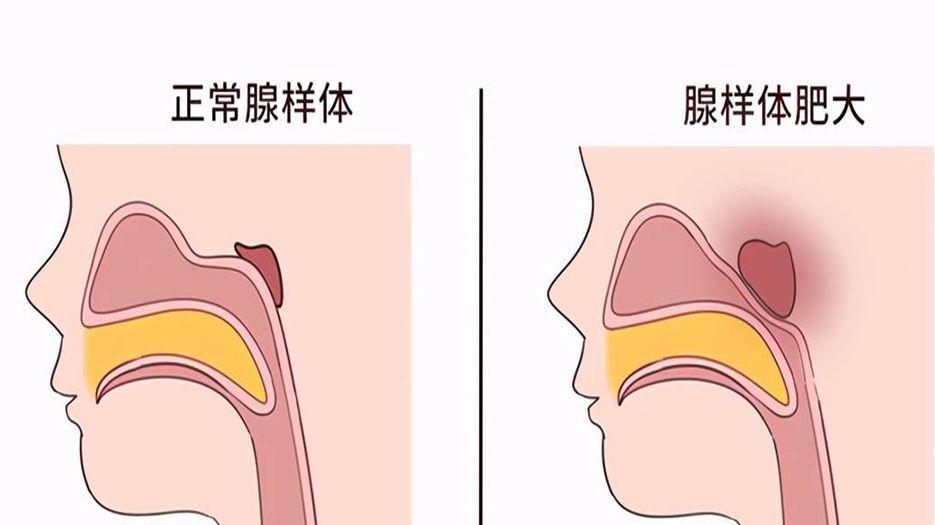 腺樣體肥大的孩子必須做手術嗎?不一定,遵醫囑治療即可-孕多多