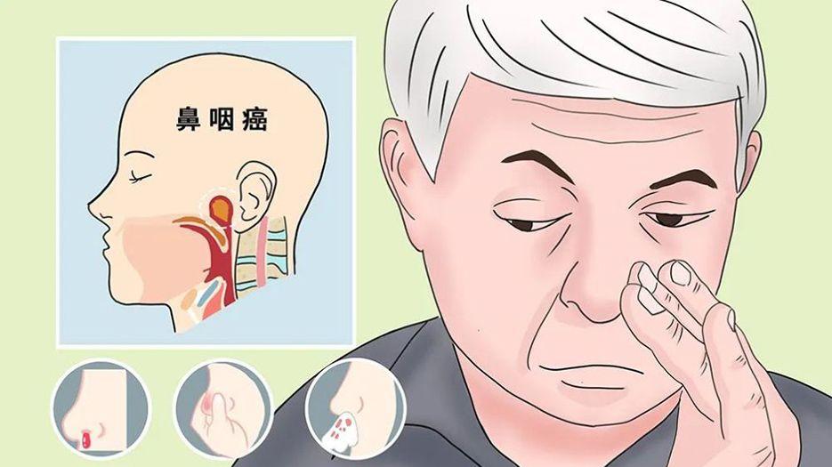 鼻咽癌.jpg